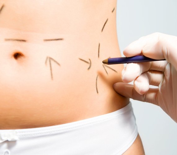 Procedure of Tummy Tuck