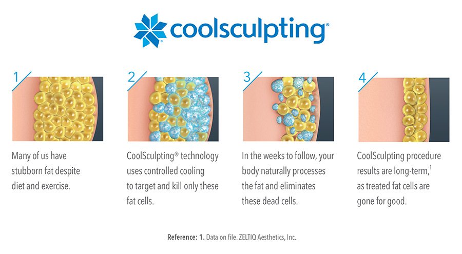 Procedure of Coolsculpting body sculpting