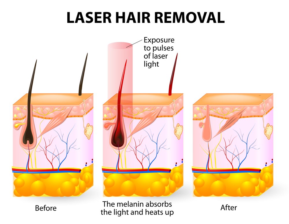 Procedure of Laser Hair Removal