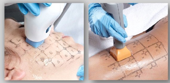 Procedure of Thermage tightening