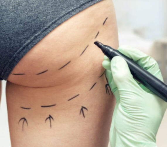 Procedure of Cellfina